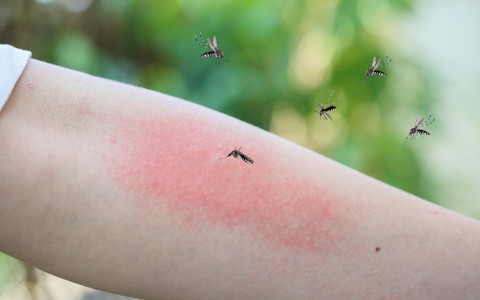 Rimedi naturali contro le punture di zanzare